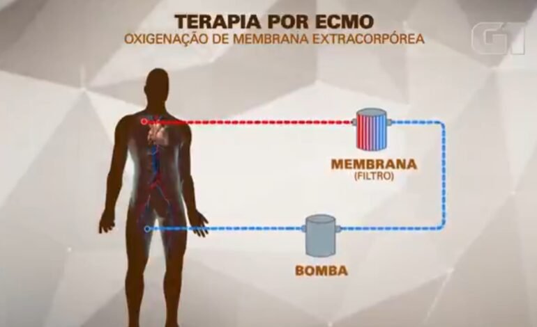 ECMO: entenda como funciona a terapia usada em MC Marcinho Um dos maio
