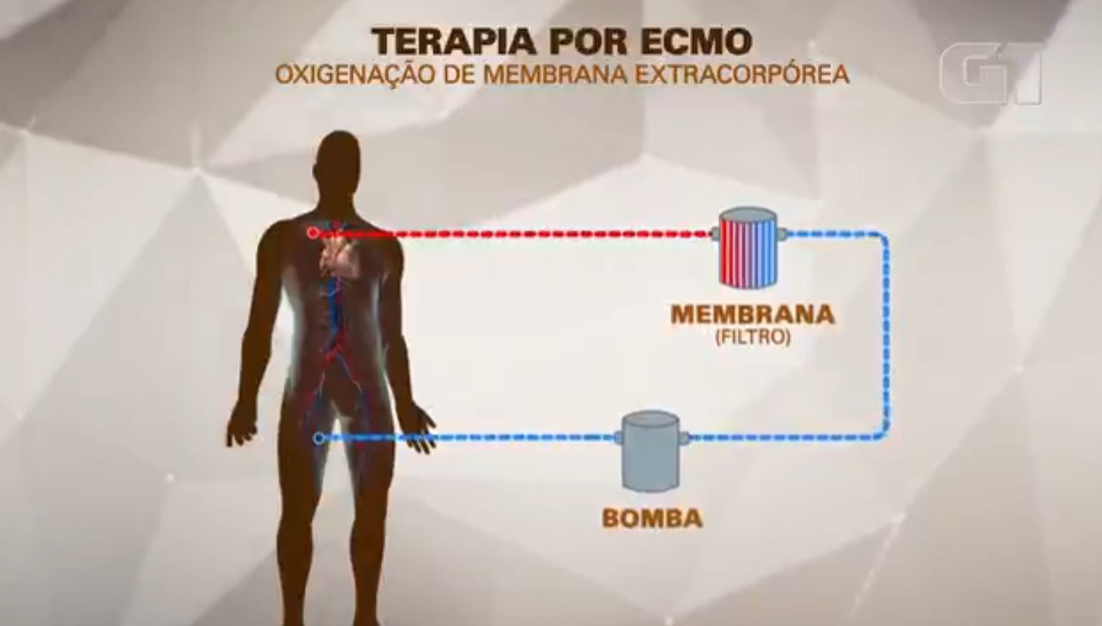 ECMO: entenda como funciona a terapia usada em MC Marcinho Um dos maio